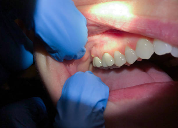 Best Cracked Tooth Emergency Dentist  in West Wood, UT